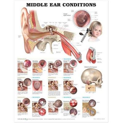 Middle Ear Conditions Anatomical Chart, Nonbook von , Wolters Kluwer Health, 978-1-60547-096-2