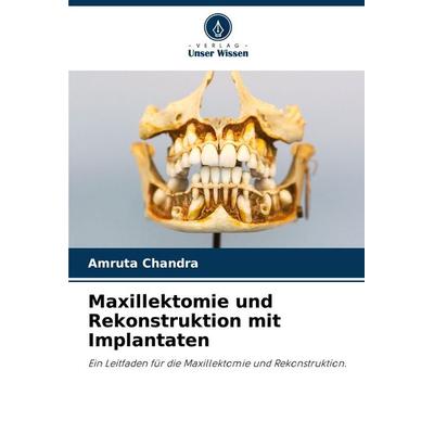 Maxillektomie und Rekonstruktion mit Implantaten, Taschenbuch von Amruta Chandra, Verlag Unser Wissen, 978-620-0-08031-8