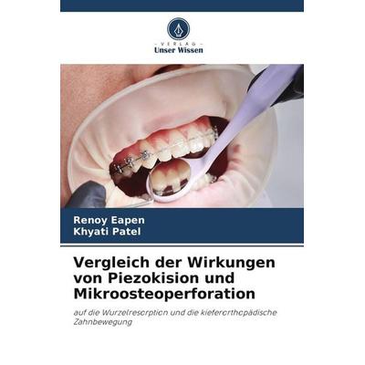 Vergleich der Wirkungen von Piezokision und Mikroosteoperforation, Taschenbuch von Renoy Eapen,Khyati Patel, Verlag Unser Wissen