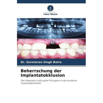 Beherrschung der Implantatokklusion, Taschenbuch von Gursimran Singh Batra, Verlag Unser Wissen
