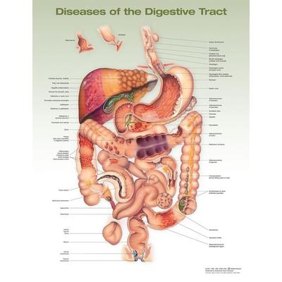 Diseases of the Digestive Tract Anatomical Chart, von Anatomical Chart Company Acc, Ingram Publishers Services, 978-1-975243-25-8