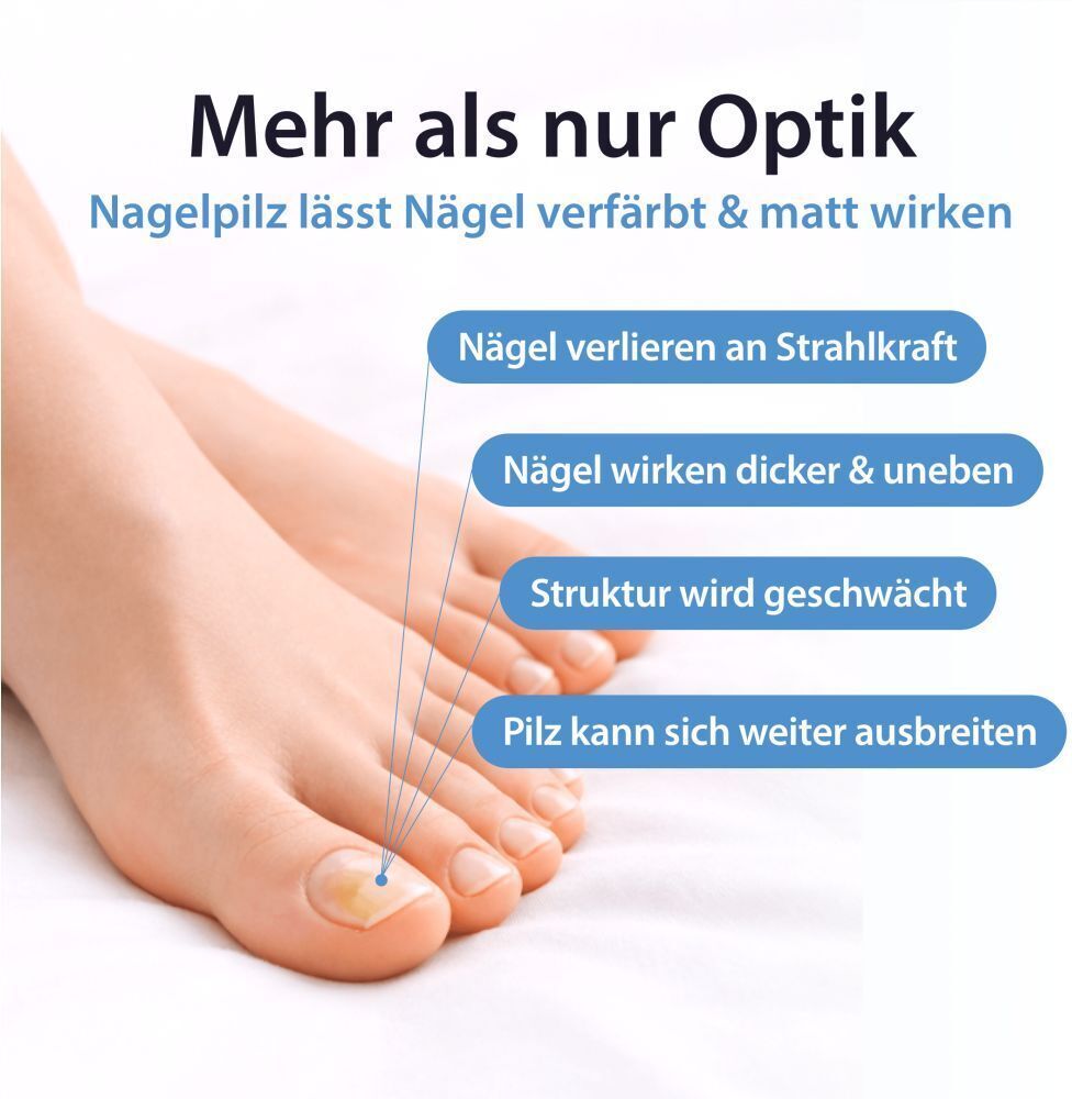 Acetocaustin Nagelpilz Lösung mit Aufhellung 9 ml