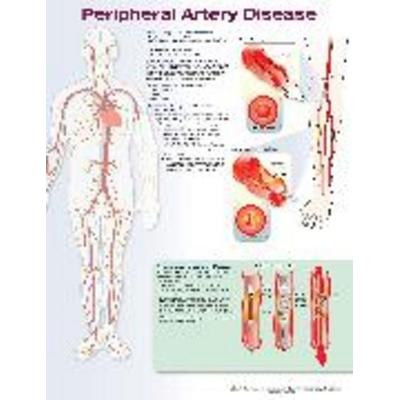 PERIPHERAL ARTERY DISEASE LAMINATE CHART, von Tbd, Ingram Publishers Services, 978-1-4963-7001-3
