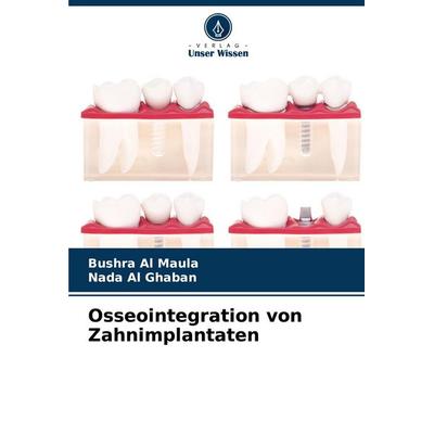 Osseointegration von Zahnimplantaten, Taschenbuch von Bushra Al Maula,Nada Al Ghaban, Verlag Unser Wissen, 978-620-8-06056-5