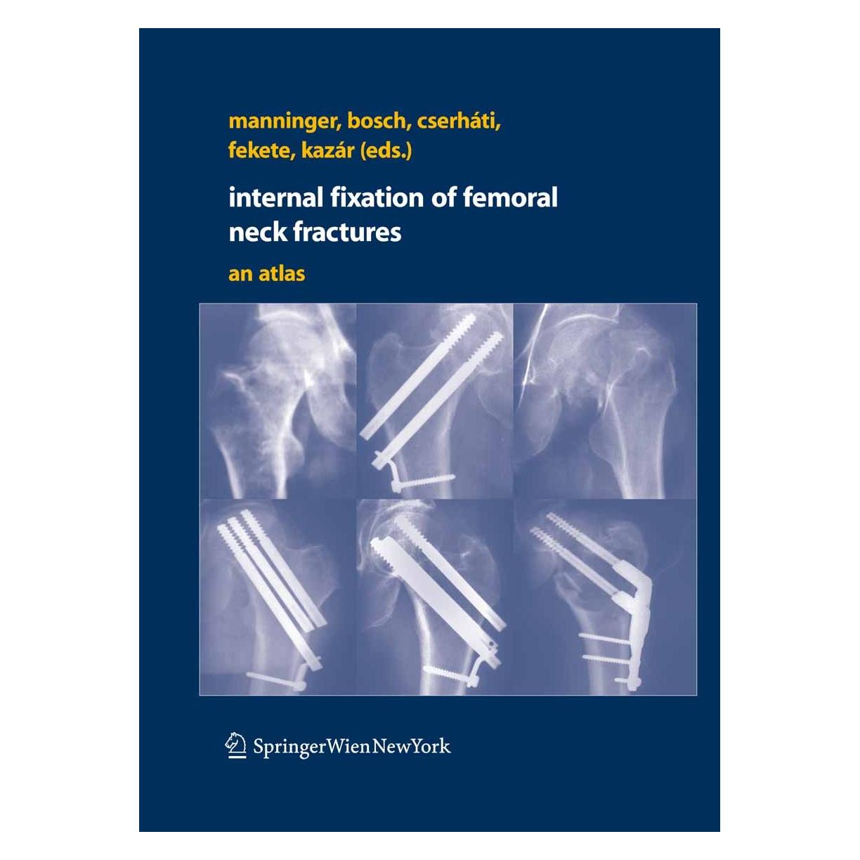 Springer Internal fixation of femoral neck fractures (Englisch, Hardcover, György Kazár, Jenő Manninger, Károly Fekete, Péter Cserháti, Ulrich Bosch) (9783211685839)