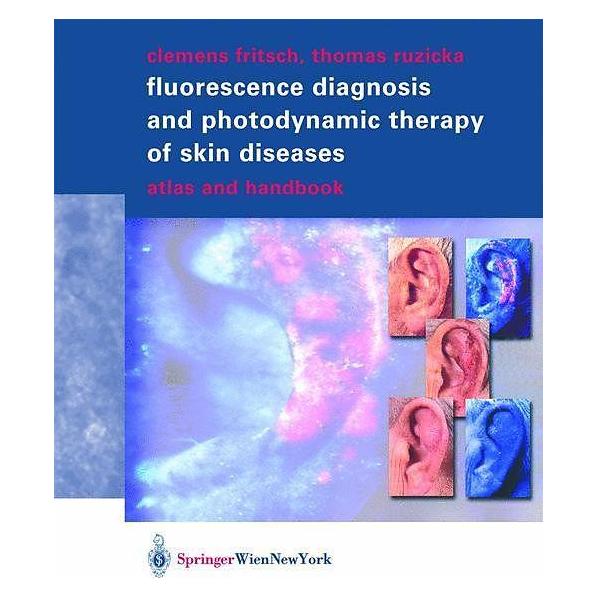 Springer Fluorescence Diagnosis and Photodynamic Therapy of Skin Diseases (Englisch, Softcover, Clemens Fritsch, Thomas Ruzicka) (9232789)