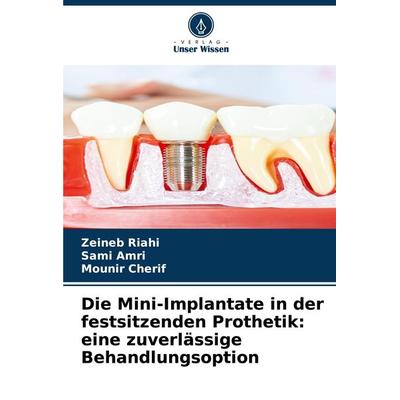 Die Mini-Implantate in der festsitzenden Prothetik: eine zuverlässige Behandlungsoption, Taschenbuch von Zeineb Riahi,Sami Amri,Mounir Cherif, Verlag